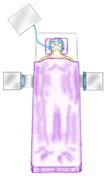 Anterior Lumbar Interbody Fusion (ALIF)
