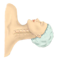 Anterior Cervical Discectomy w/ Fusion