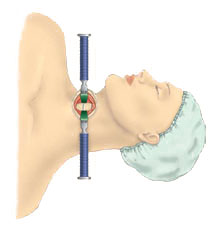 Anterior Cervical Discectomy w/ Fusion