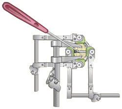 Anterior Cervical Discectomy w/ Fusion