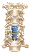 Anterior Cervical Discectomy w/ Fusion