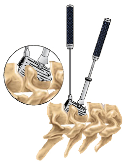 Cervical Corpectomy