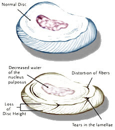 Degenerative Disc Disease