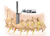 Cervical Foraminotomy