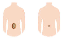 Transforaminal Lumbar Interbody Fusion (PLIF)