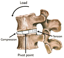 Degenerative Disc Disease