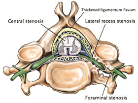 Stenosis