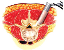 Transforaminal Lumbar Interbody Fusion (PLIF)