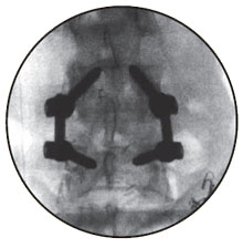 Transforaminal Lumbar Interbody Fusion (PLIF)