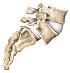 Spondylolisthesis