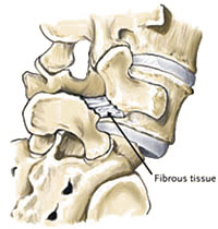 Spondylolisthesis