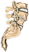 Spondylolisthesis