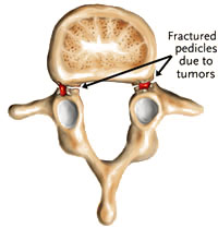 Spondylolisthesis